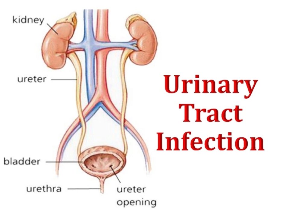 How to prevent urinary tract spasms: Tips for a healthy bladder